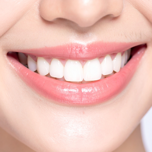 Facetas em Resina: vale a pena? Entenda quando esse tratamento é indicado